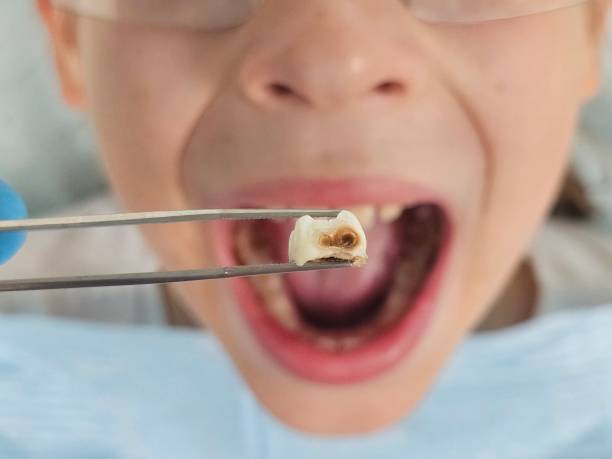 Best Emergency Dentist for Knocked-Out Tooth in Spring Lake, MI